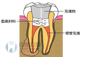 牙医解说什么是牙周病？