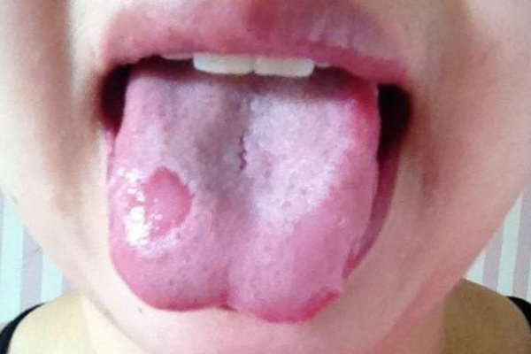 口腔溃疡导致的大便怎么办？