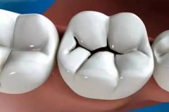 如何避免孩子牙齿出现龋坏？