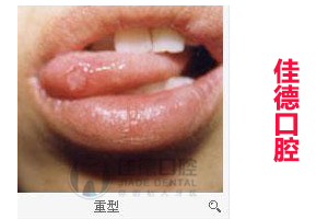 口腔溃疡导致的腹泻该怎么办？