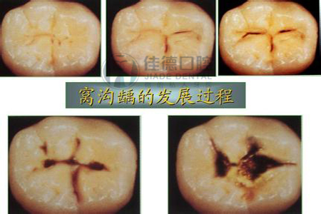 盘点牙痛要怎么快速止痛呢？