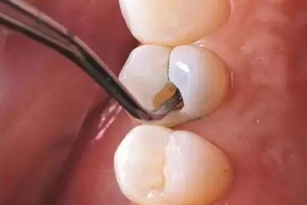 医治牙髓发炎做根管的价格是多少？