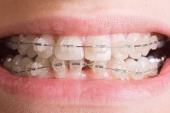 牙齿做矫正拔牙有没有危害？
