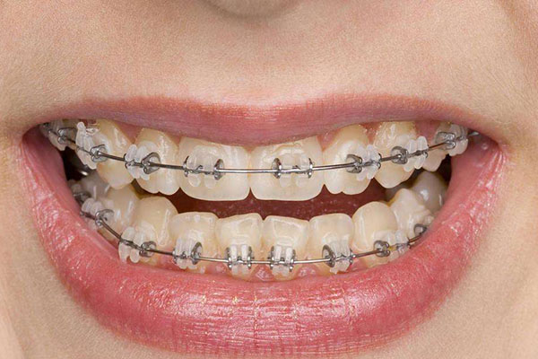 合肥牙齿矫正多少钱？