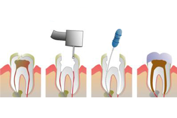 根管的治疗有哪些的优势呢？