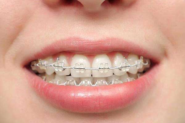 合肥哪里做牙齿矫正好？