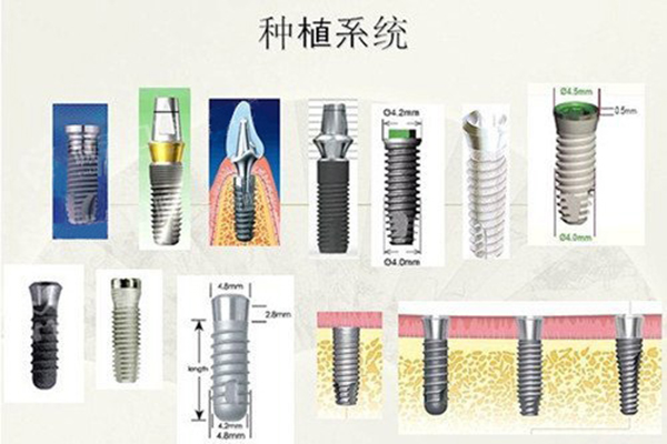 决定种植牙费用的四方面因素？