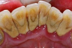 牙周炎是成人失牙主要原因？