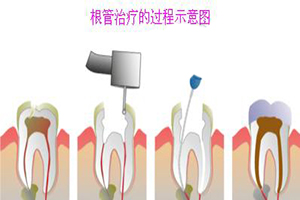 补完牙之后还是觉得牙疼怎么办?