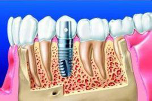 种植牙手术过程究竟是怎么样的？