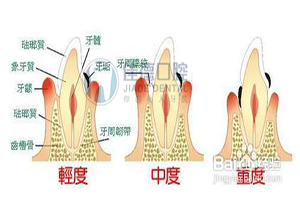 牙齿问题的修复治疗有哪些？