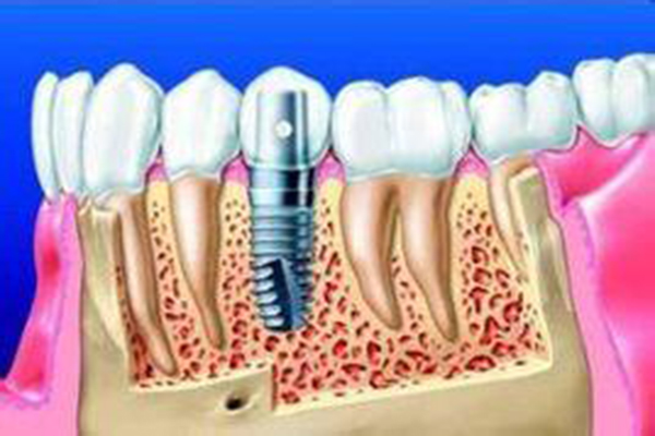 种植牙后，牙痛该怎么办呢？