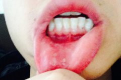 反复性口腔溃疡怎么应急治疗？