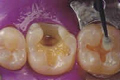 关于怎样预防孩童门牙龋坏？