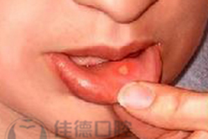 口腔溃疡
