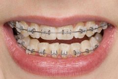 牙齿错位怎么矫正？