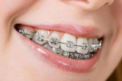 青少年牙齿外突怎么治疗？