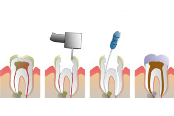 根管的治疗的治疗步骤都有哪些？