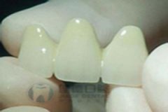钴洛合金烤瓷牙具有哪些优点？