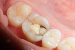 牙痛常见的六大原因？