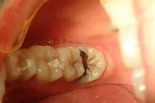 长智齿牙疼该怎么办？