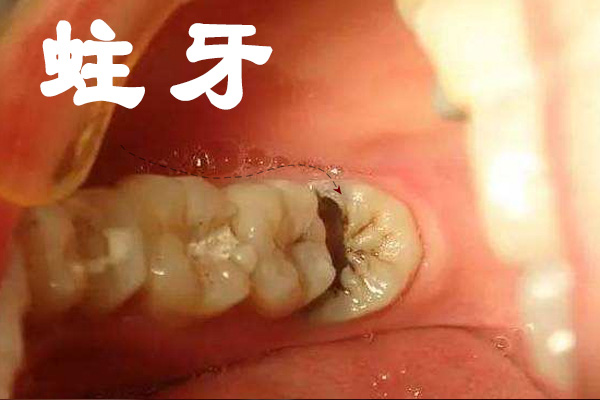 分析蛀了牙产生的原因？