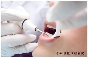 合肥洗一次牙多少钱_佳德口腔洗牙三种价位