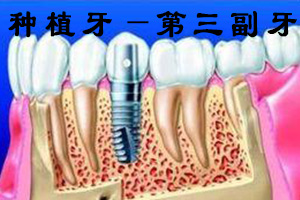 合肥做种植牙选什么系统好呢？