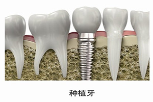 拔牙后马上种植牙要多少钱?