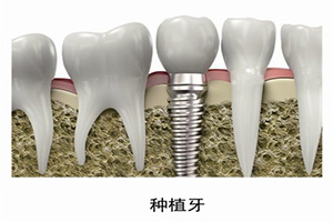 种植牙的成功率到底是多少呢?