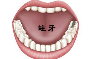 补牙跟洗牙哪个先好？