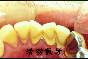 牙结石形成原因及为什么会出现？
