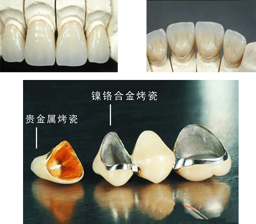 烤瓷牙的种类及价钱?