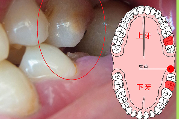 拔智齿的注意事项？