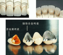 关于烤瓷牙的详细内容有哪些？