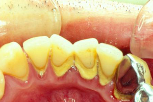 牙齿疾病的危害有哪些？