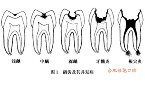 怎么尽快治疗孩子的龋坏？