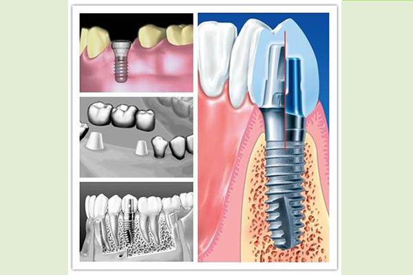 种植牙的材质都有哪些？
