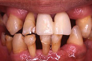 介绍牙周萎缩的几大类型？