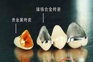 合肥口腔烤瓷牙价格?