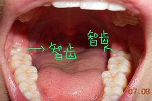 长智齿牙龈肿痛怎么办?