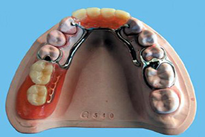 固定假牙和活动假牙哪个好？
