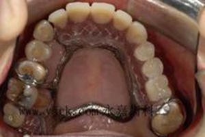 活动义齿与固定义齿哪个更好点？