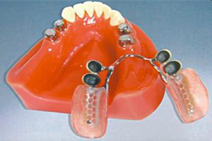 套筒冠义齿的类型有几种？