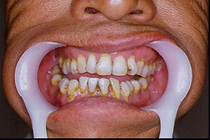颌紊乱的常见因素是什么呢？
