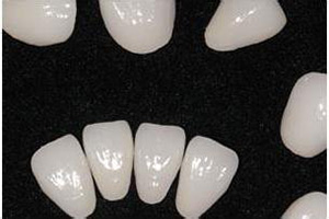 为什么要选择瓷贴面进行牙齿修复？