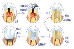 做根管的治疗需要多少钱？