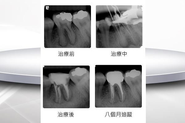 根管的治疗后牙龈肿痛怎么办？