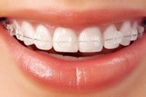合肥牙齿矫正方法