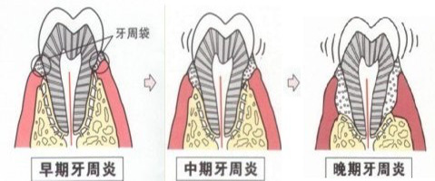 得了牙周炎该怎么治疗？